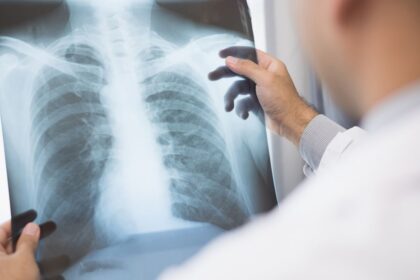 Anvisa aprova novo medicamento para câncer de pulmão avançado