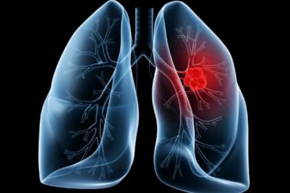 Saiba o que é adenocarcinoma pulmonar, câncer que atinge o papa